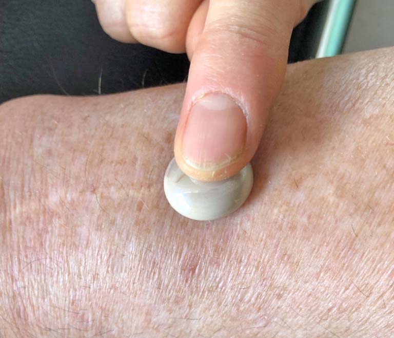 UR-13-Arm-mit-Perle-und-Finger-web Insektenstich-Retter Urteilchen